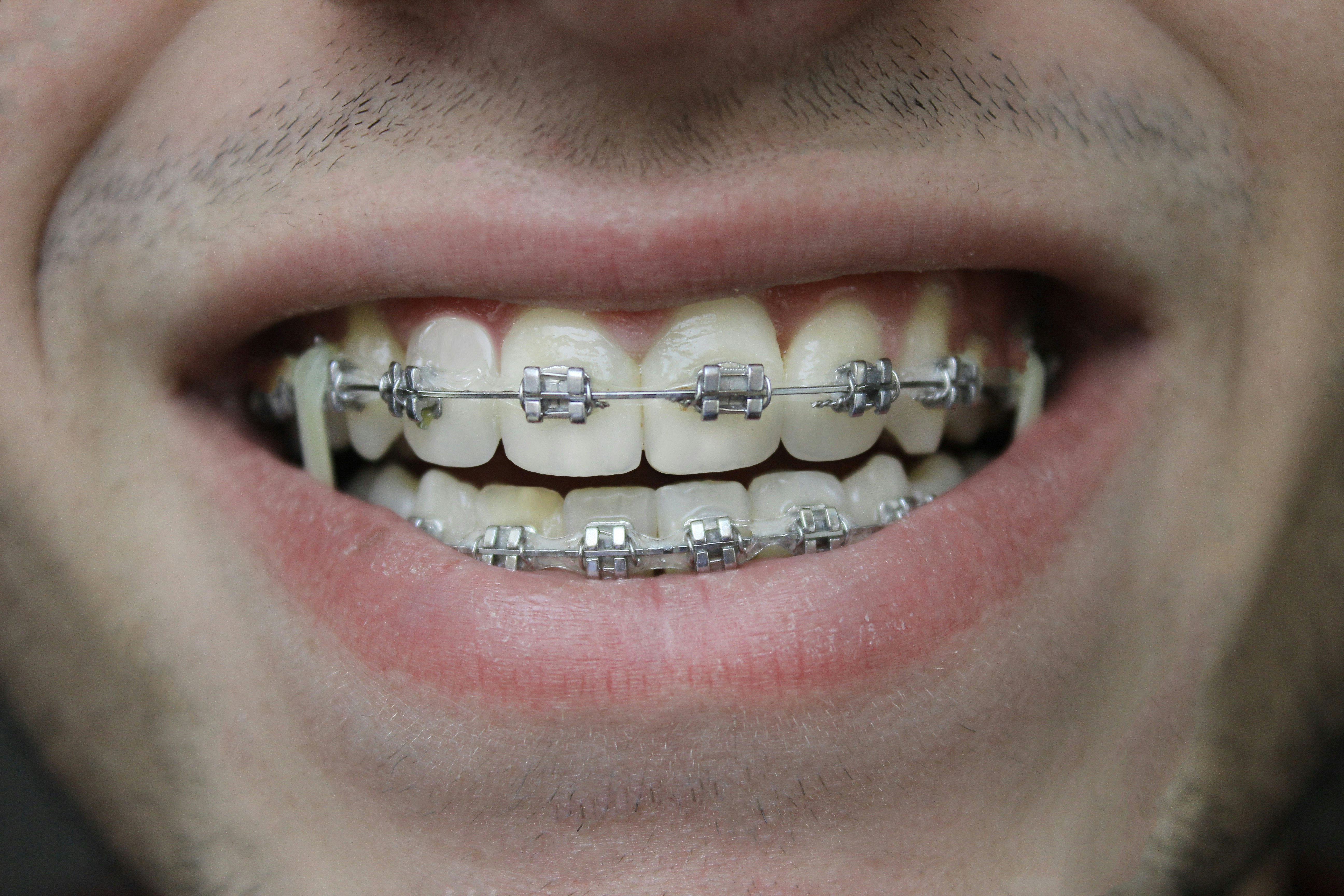 Metal & Ceramic Braces